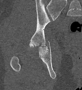 Acetabular Fracture Posterior Column